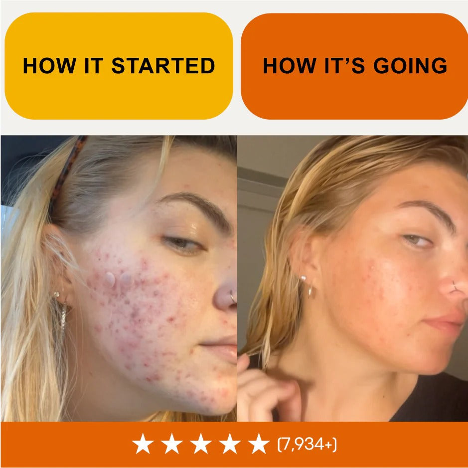 Breakout & Redness Ritual